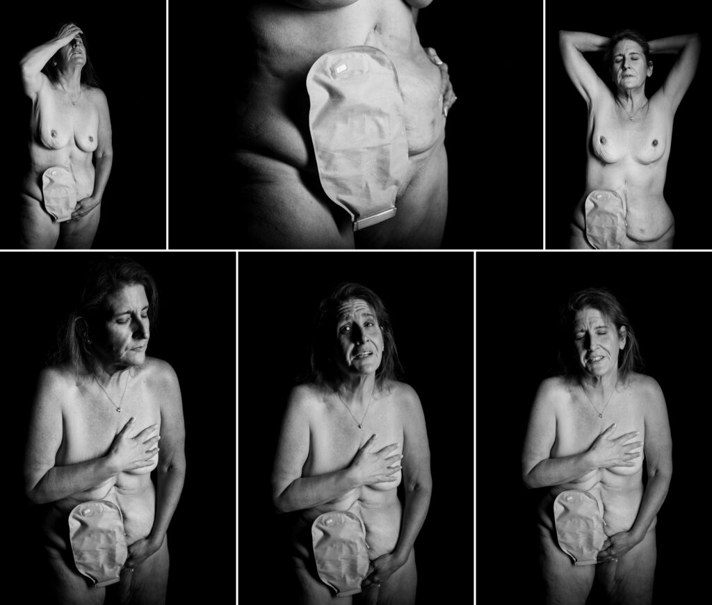 Collage of six black and white portraits of a woman with a stoma and ileostomy bag, expressing a range of raw emotions from anguish to peace, photographed against a dark backdrop.